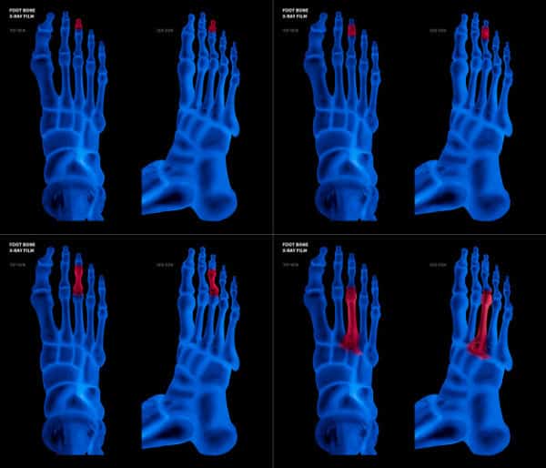 Radiografía de los huesos metatarsianos