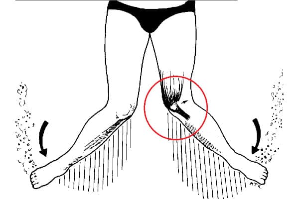 Diagrama de lesión rodilla de bracista