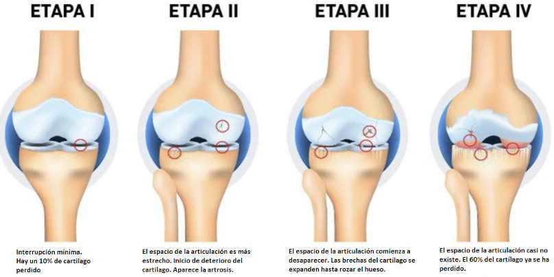Grado de avance de artrosis de rodilla