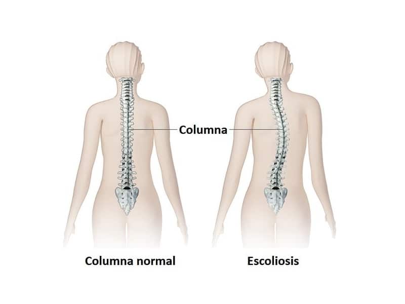 Diferencia de la columna vertebral